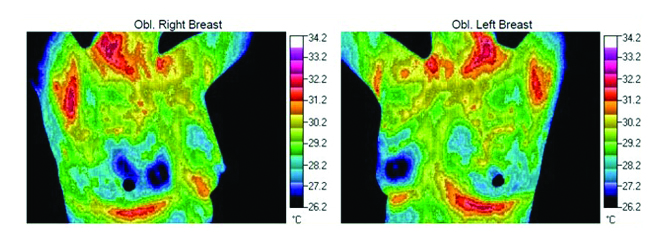 breast thermograph after treatment with Cell Matrix MD