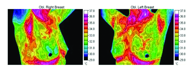 breast thermograph before treatment with Cell Matrix MD